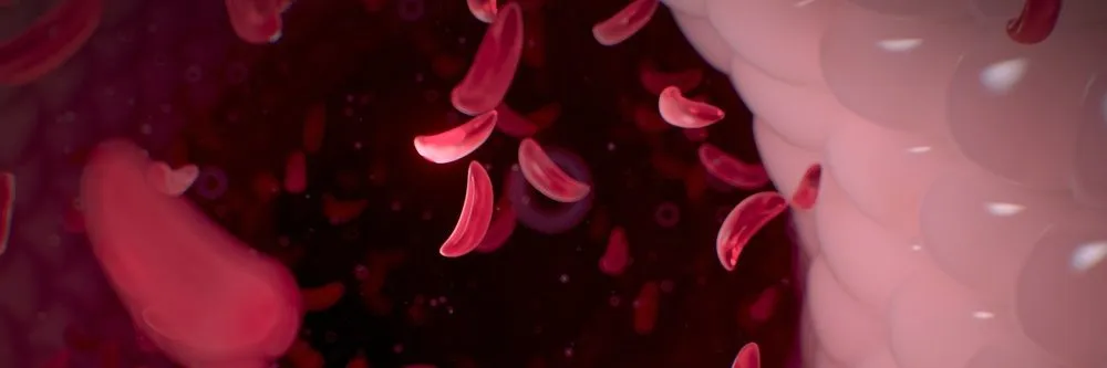 Anemia falciforme: via libera da Fda alla prima terapia genica per bambini dai due anni in su - AboutPharma
